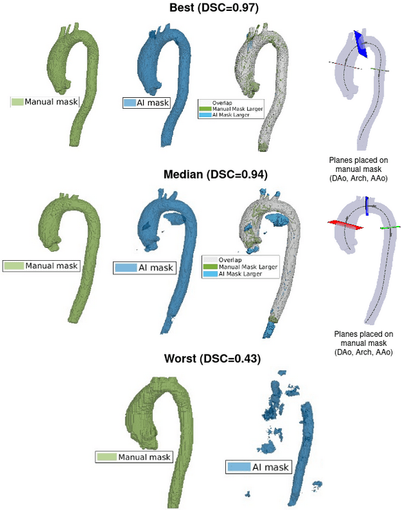 Deep learning AI for aortic diameter measurement and segmentation thumbnail